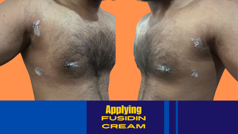 applying fusidin cream