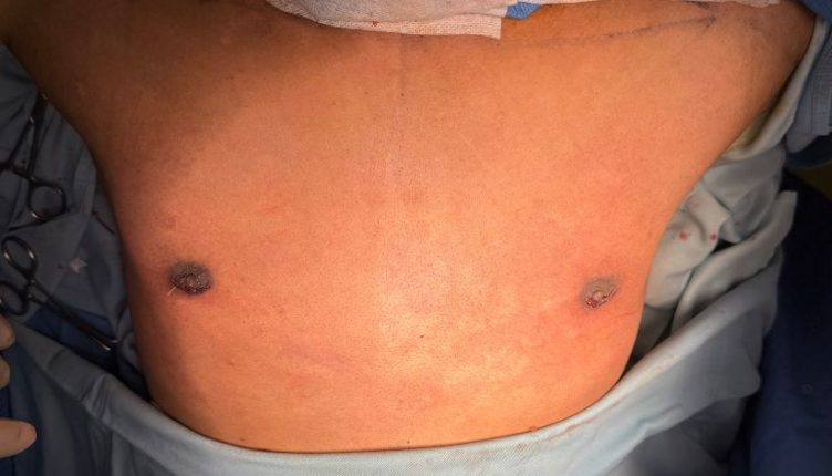 After-gynecomastia-treatment-kandy