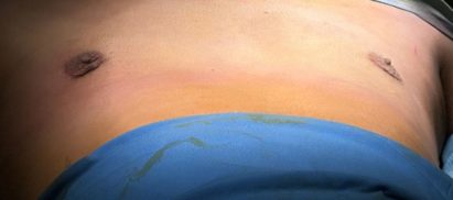 After-liposcution-gynecomastia