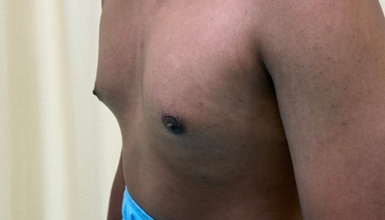 Before-gynecomastia-treatment-kandy