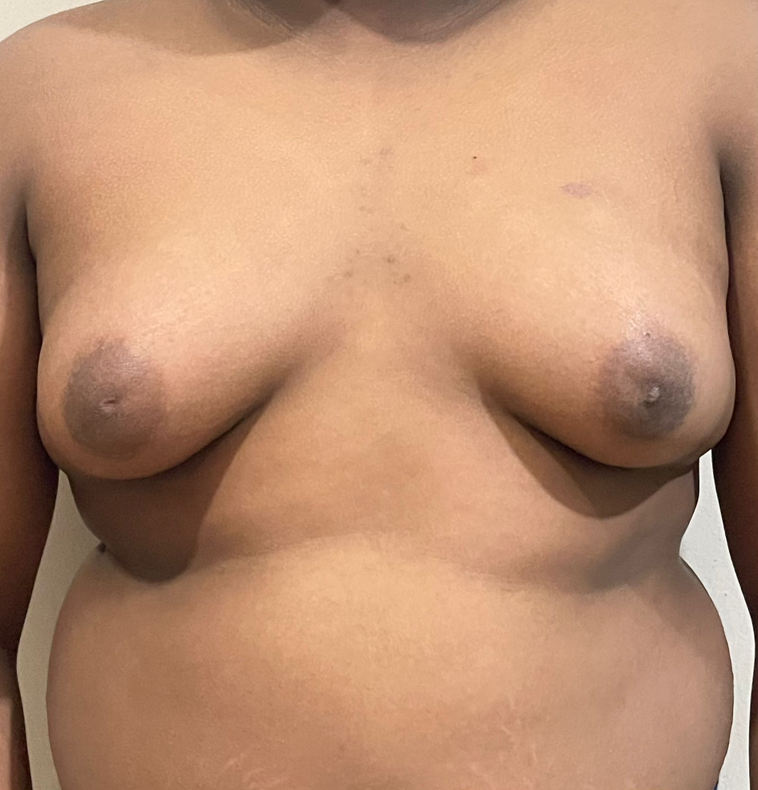 Before-liposuction-kandy