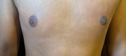 After-liposcution