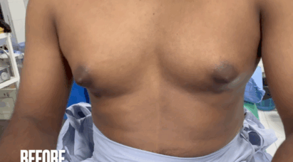 before-gynecomastia-surgery