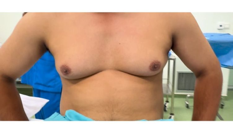before-liposuction-gynecomastia