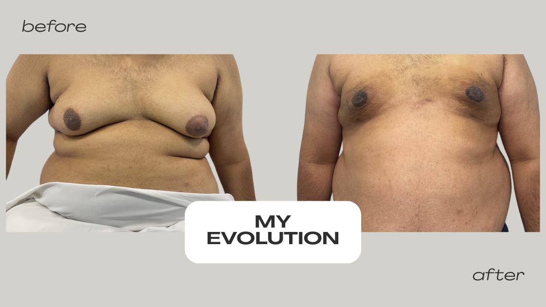 gyno-before-and-after