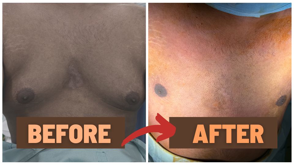 Before-and-after-results-gynecomastia-2026